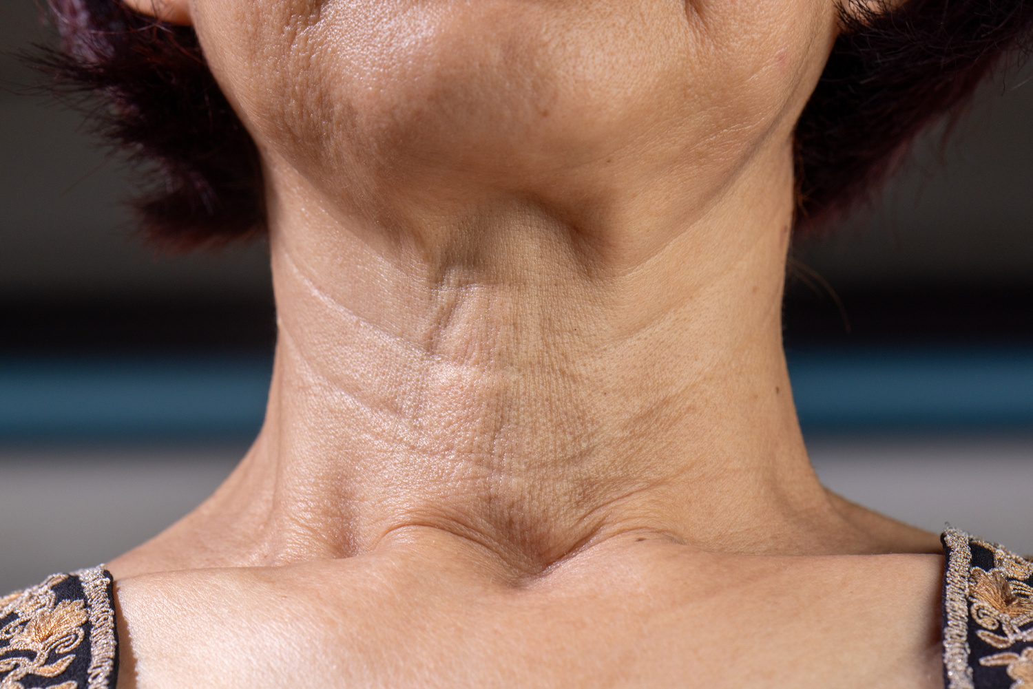 Neck lift procedure in accredited hospital setting in Turkey