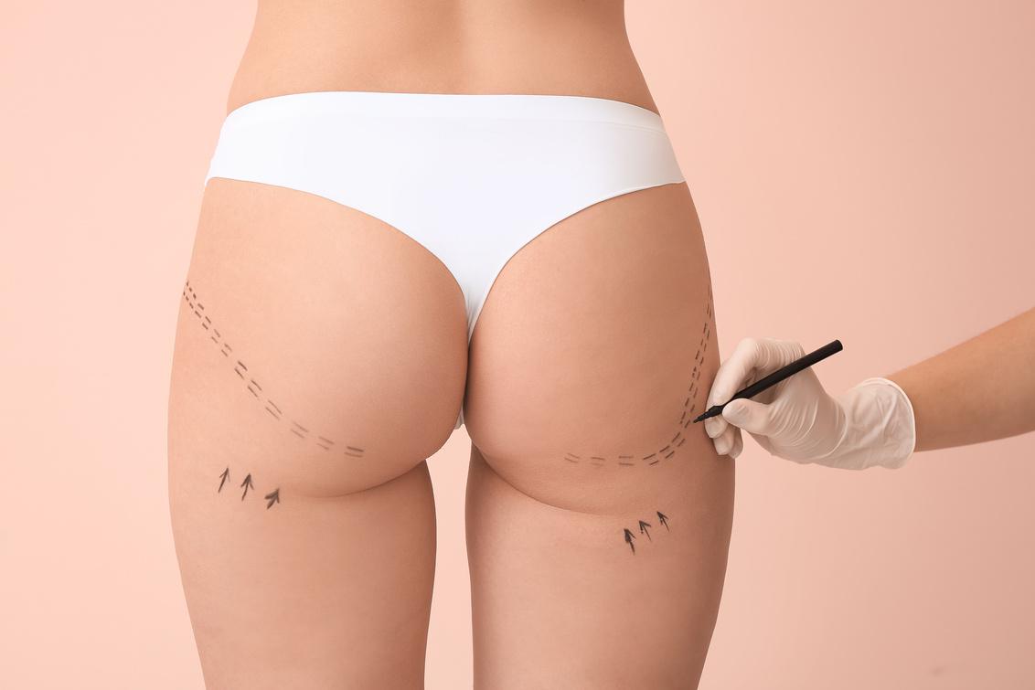 Buttock Contouring at Nova