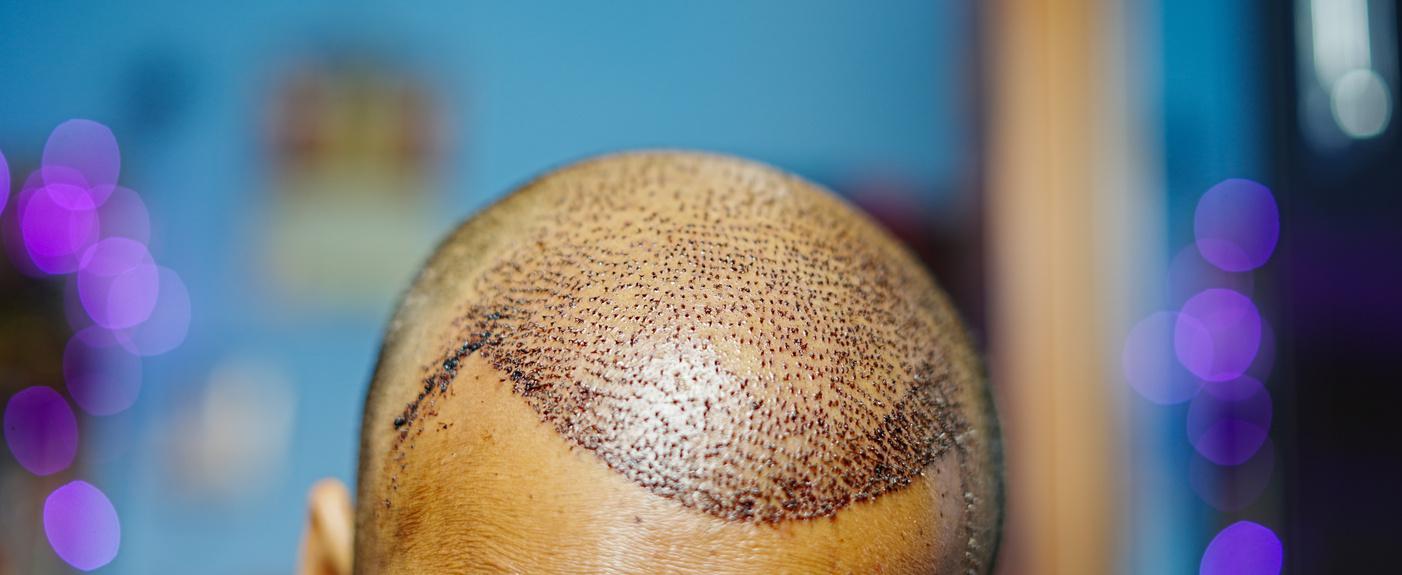Hair Transplant at Nova