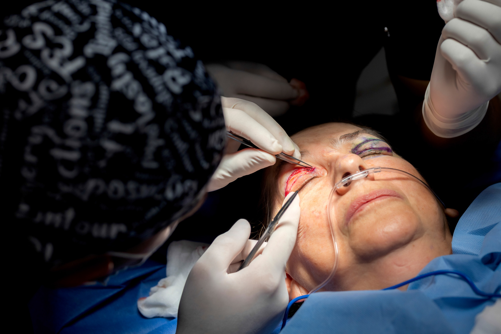 Blepharoplasty