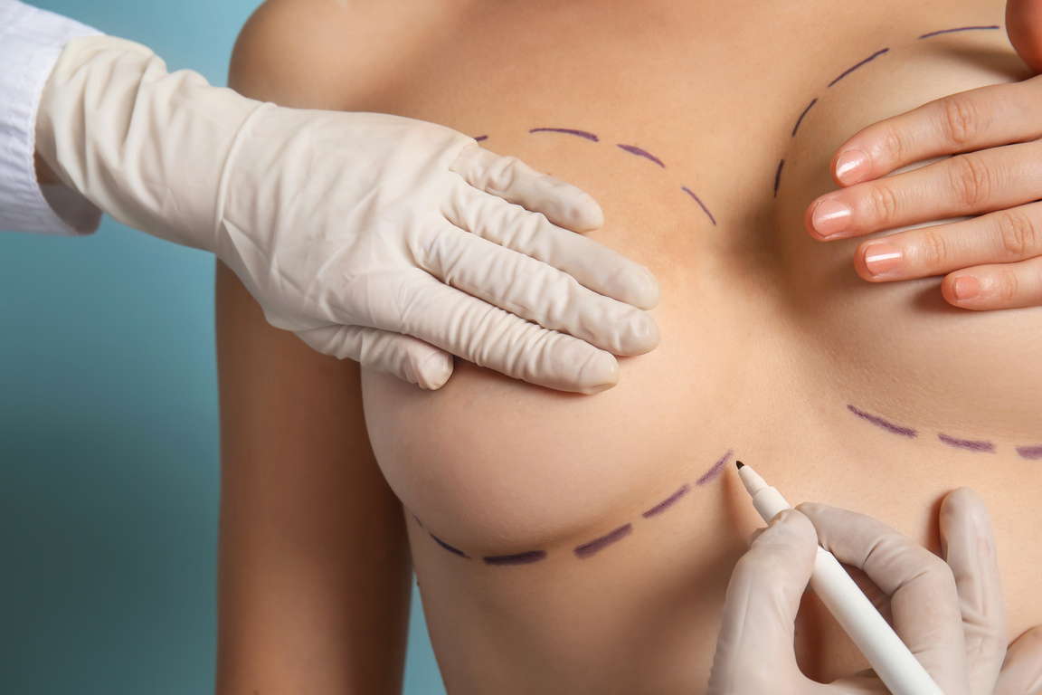 Breast Augmentation