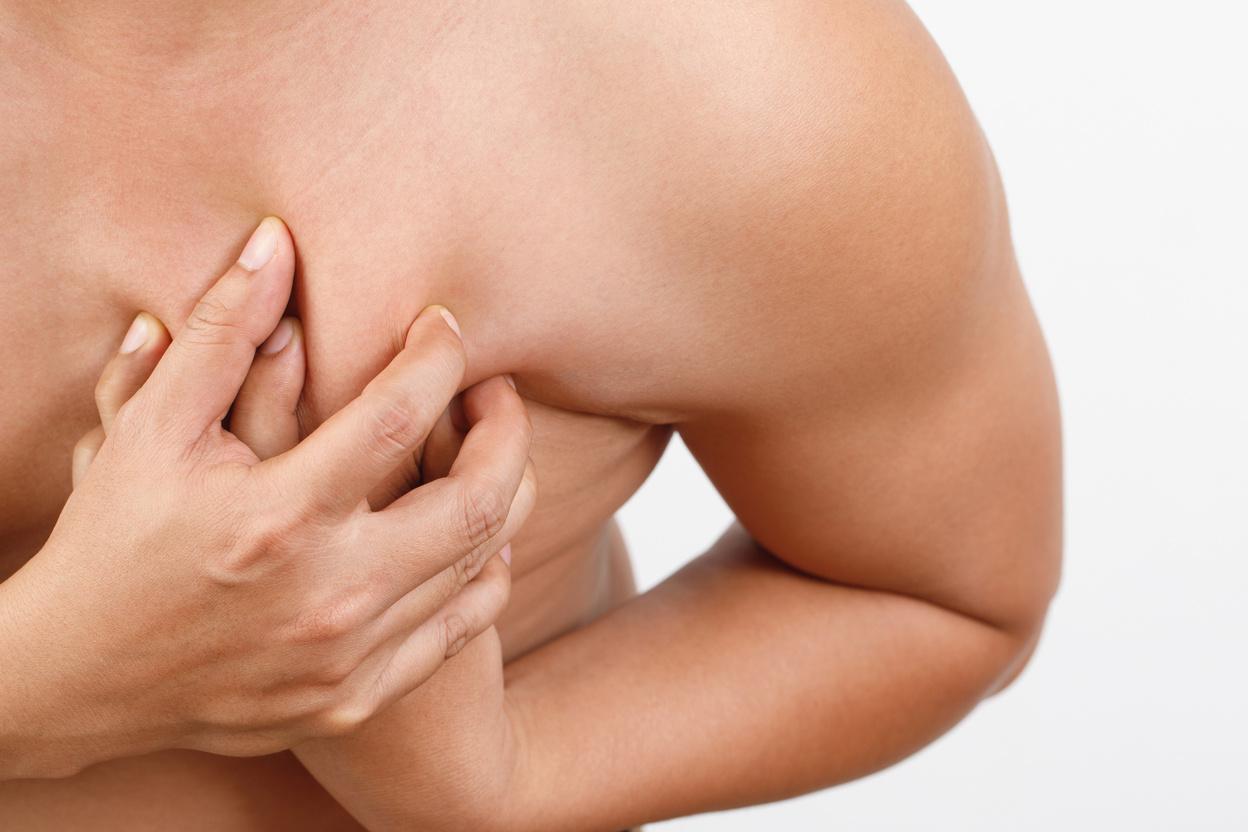 Gynecomastia