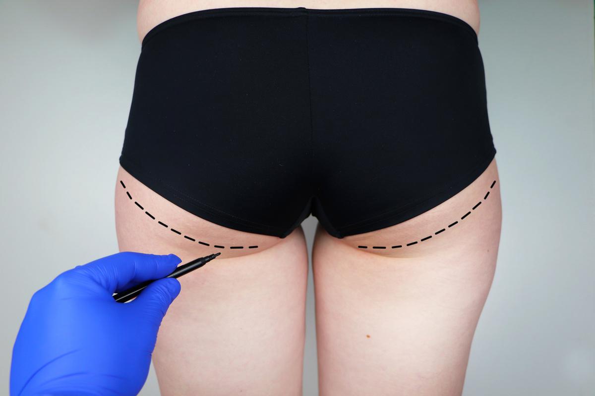 Buttock Contouring Surgery