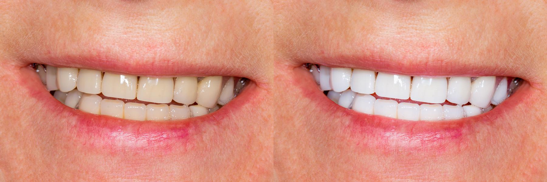 Porcelain Veneers