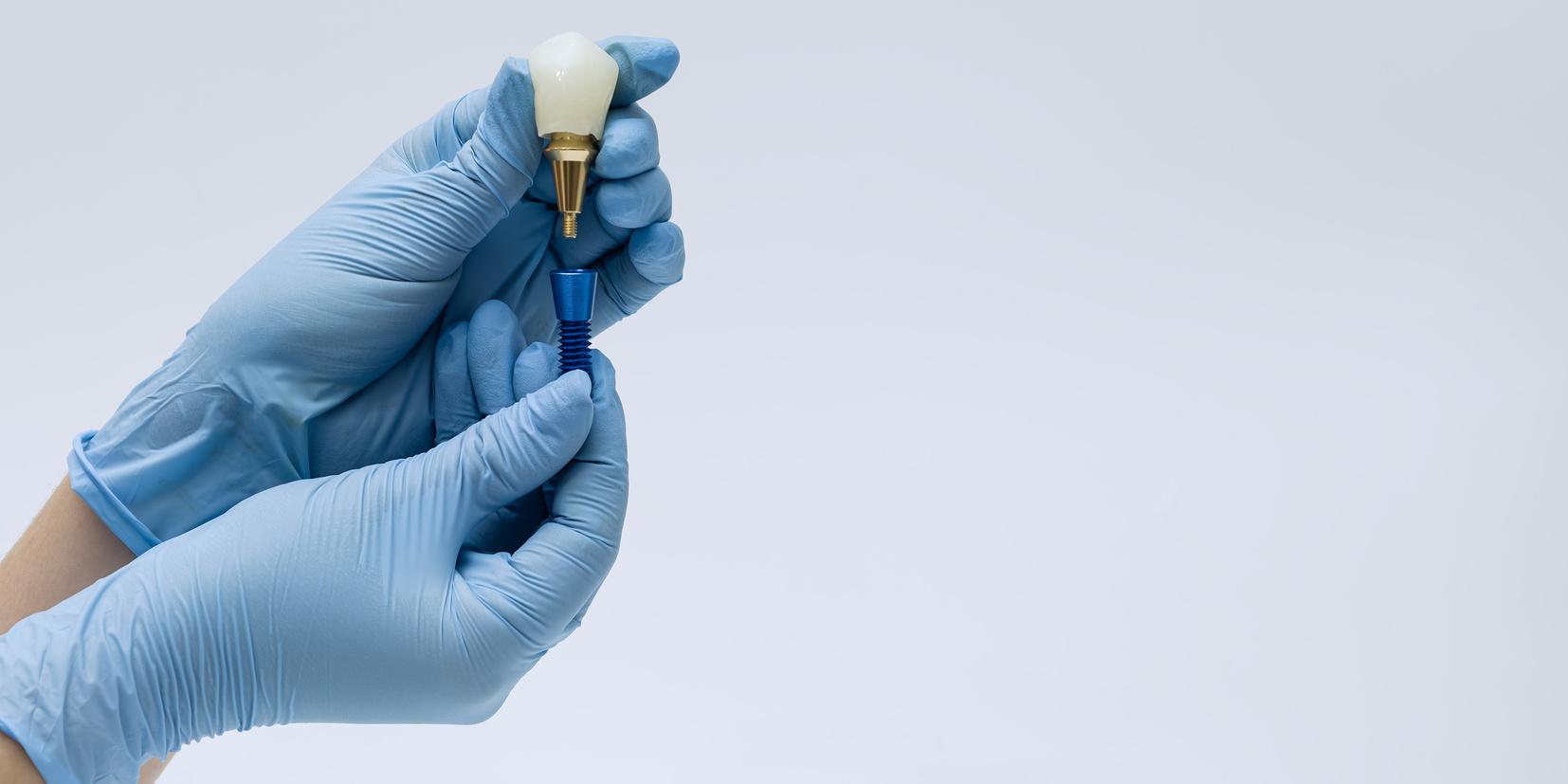 Implant Rehabilitation