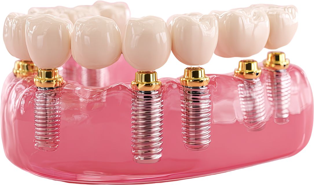Multiple Dental Implants